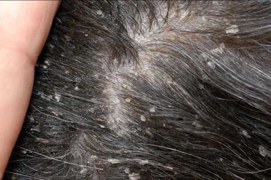 Close-up of skin affected by Cheyletiellosis walking dandruff on Scottish terrier
