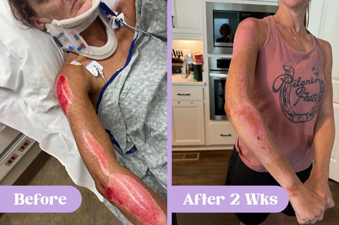 Before and after comparison; left photo: woman in hospital bed with severe road rash burns on right shoulder and arms; right photo: woman stands in kitchen, with burns showing remarkable recovery after two weeks of Lavengel® treatment