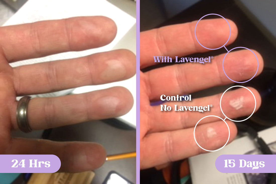 Before and after comparison showing burn blisters on a person's fingertips at 24-hours and 15-day post burn, with the after photo highlighting improved healing results with Lavengel® compared to without 