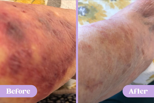 Before and after comparison of an elderly person's arm with visible red skin lesions in left photo versus clear skin in right photo
