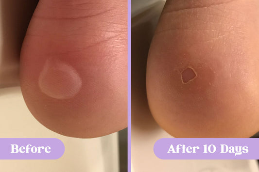 Before and after comparison of a 0.5-inch fluid blister on a person's heel, treated and healed with Lavengel® for 10 days
