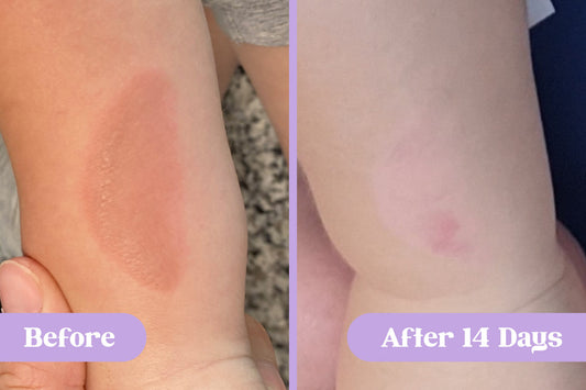 Before and after comparison of a burn on a child's arm healed after 14 days of treatment with Lavengel®