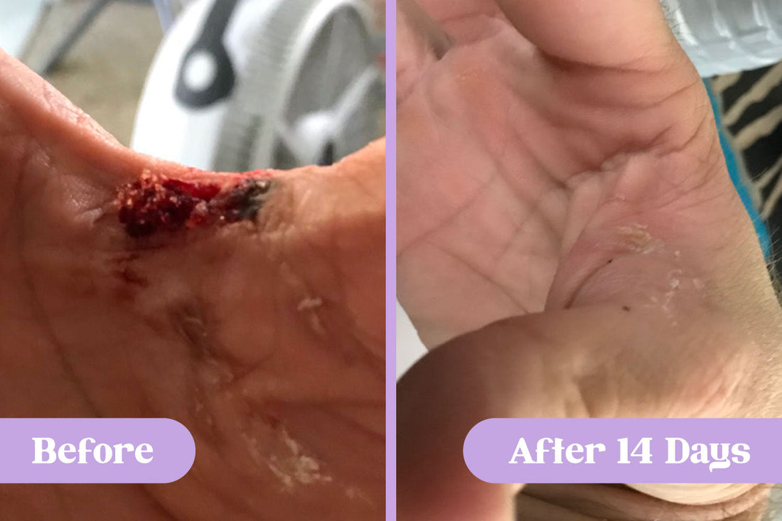 Before and after comparison of a significant wound with debris on a hand at lower thumb joint versus the same hand healed with minor scabbing and skin flakes