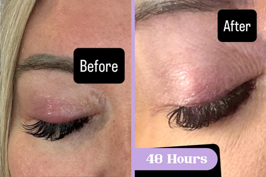 Before and after comparison of a stye on a woman's eyelid treated with Lavengel® for 48 hours, with reduced swelling and redness in after photo